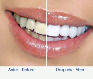 Solución Dental - Diseño de Sonrisa 