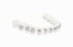 Solucion Dental Colombia SmartclipSL3 Brackets